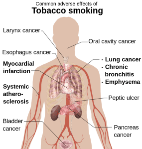 Wikiemedia Commons Adverse_effects_of_tobacco_smoking_svg